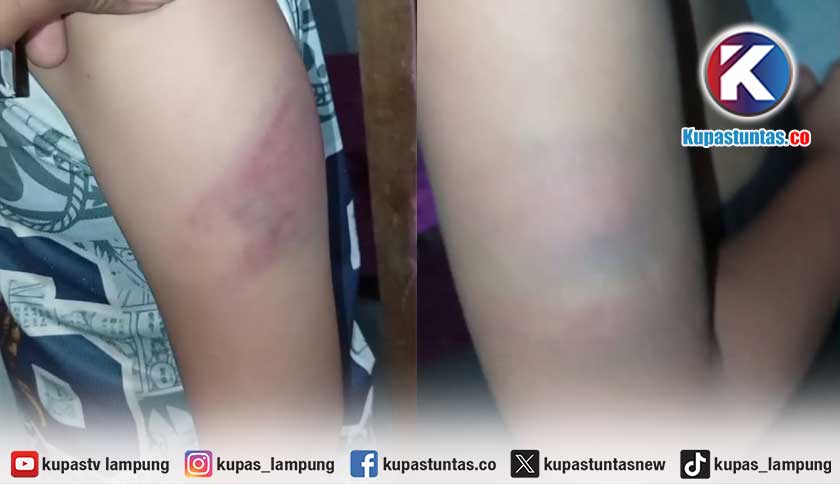 Lengan Dua Siswa SD di Pringsewu Lebam, Diduga Dipukul Guru Pakai Gagang Sapu