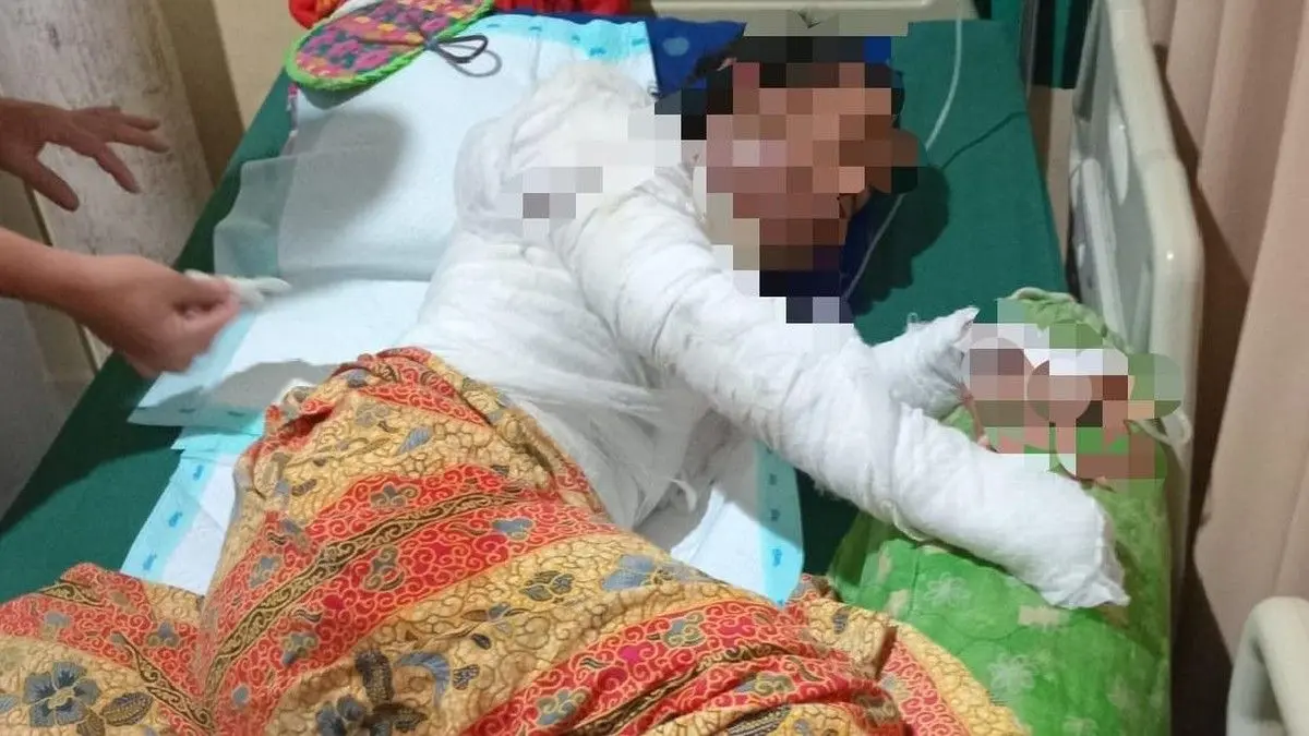 Diduga Dibakar Suami Akibat Cekcok Cemburu, Ibu Dua Anak di Metro Minta Keadilan